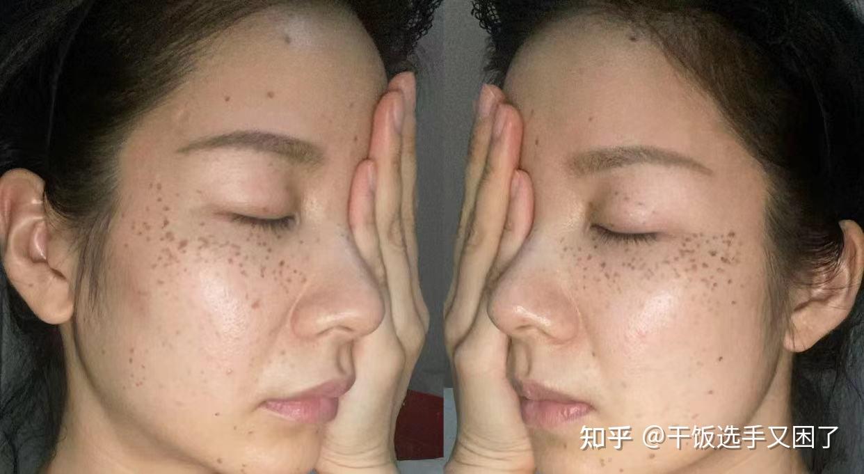 颜大师使用一个月脸颊斑点对比图