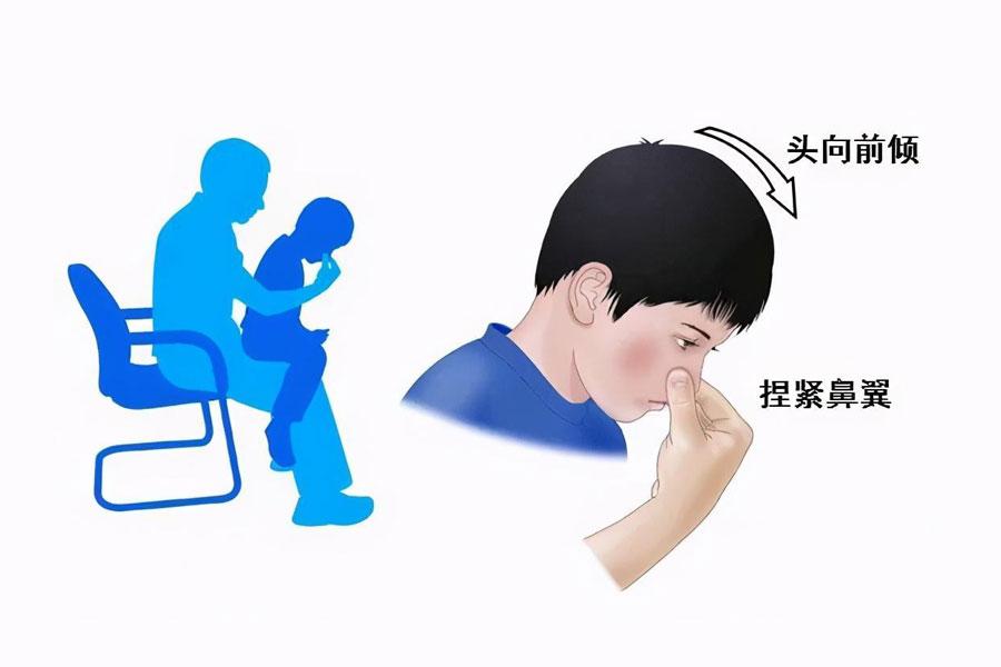 熟见流鼻血正确处理 仰头误区急救常识