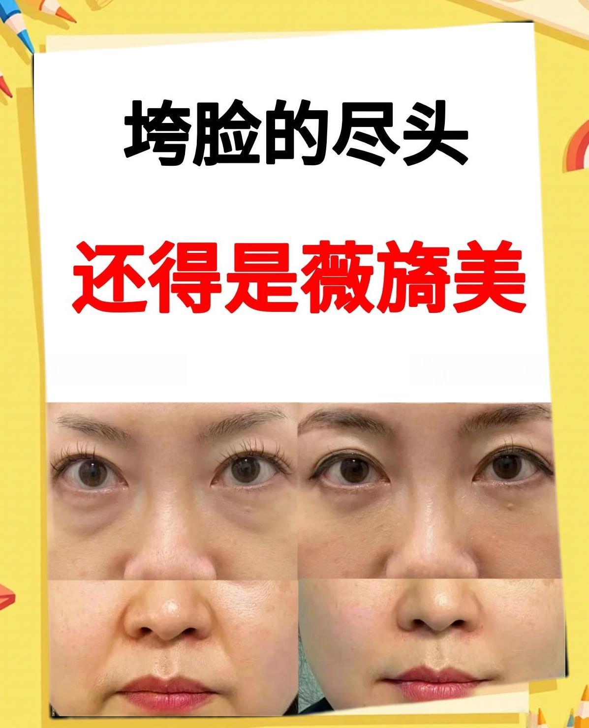 薇伊美V入手避坑指南 薇伊美V正确使用方法与注意事项