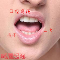 起嘴泡是什么原因怎么快速消除 嘴角水泡护理实拍图